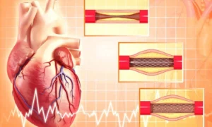Read more about the article Selective Coronary Thrombectomy: CRM, June 2025 Study Finds No Increased Stroke Risk in High-Thrombus STEMI