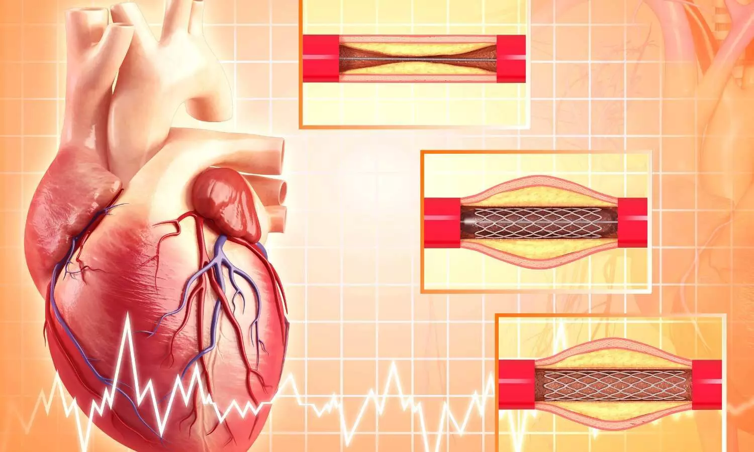 You are currently viewing Selective Coronary Thrombectomy: CRM, June 2025 Study Finds No Increased Stroke Risk in High-Thrombus STEMI
