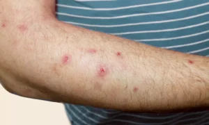 Read more about the article Nemolizumab Demonstrates Sustained Long-Term Benefit in Prurigo Nodularis: Study