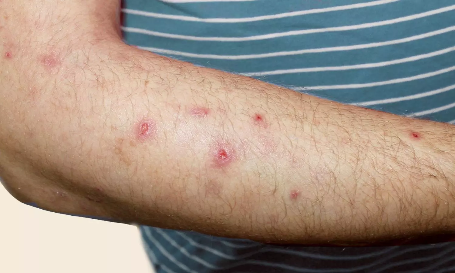 Read more about the article Nemolizumab Demonstrates Sustained Long-Term Benefit in Prurigo Nodularis: Study