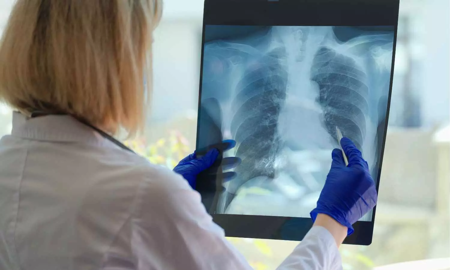 You are currently viewing Inhaled Treprostinil Slows Disease Progression in idiopathic pulmonary fibrosis: NEJM