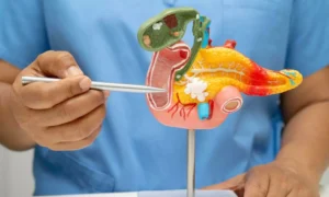 Read more about the article ERCP With Minor Papillotomy Fails to Prevent Recurrent Pancreatitis: JAMA