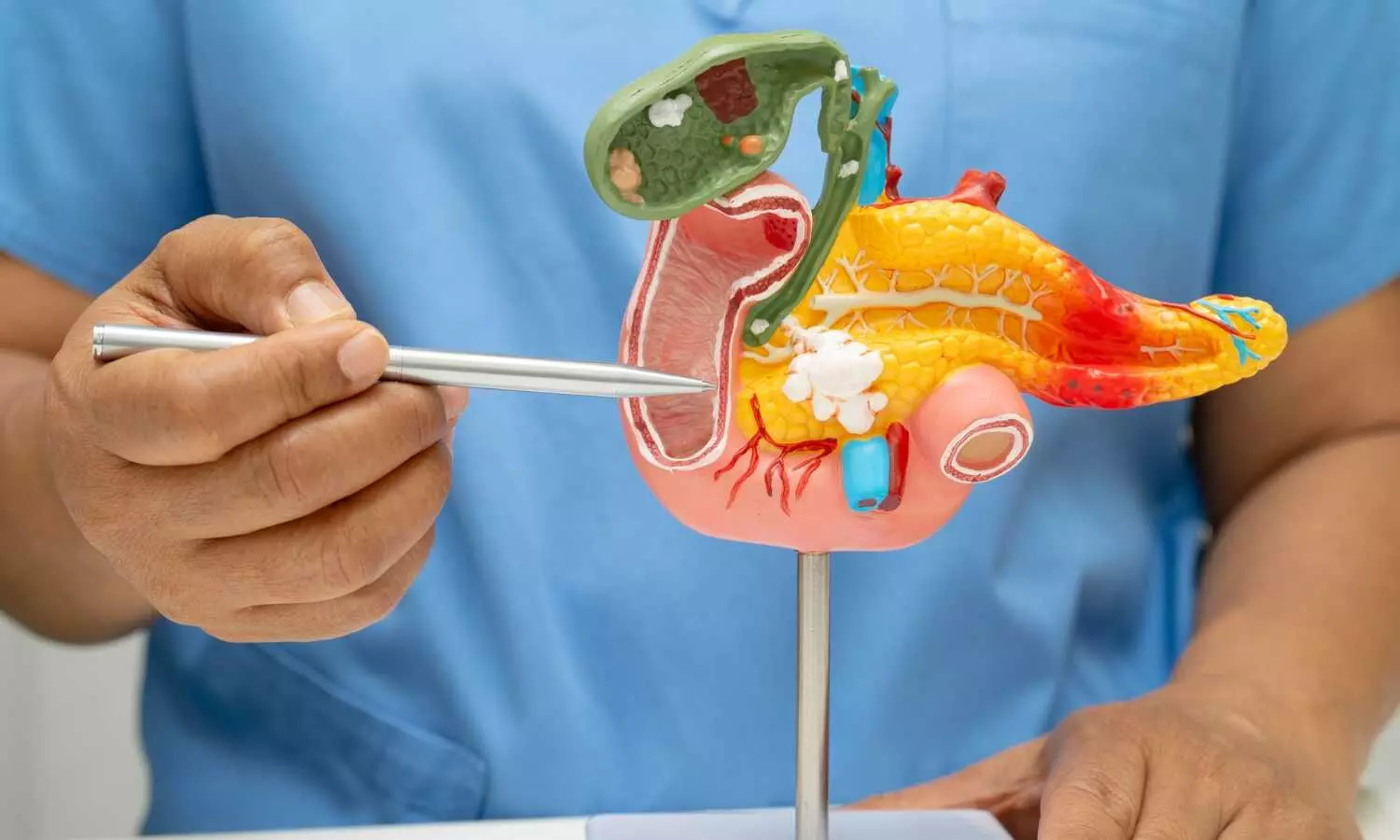 You are currently viewing ERCP With Minor Papillotomy Fails to Prevent Recurrent Pancreatitis: JAMA