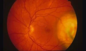 Read more about the article Patients with floaters or flashes could face higher risk of retinal detachment,  reveals research