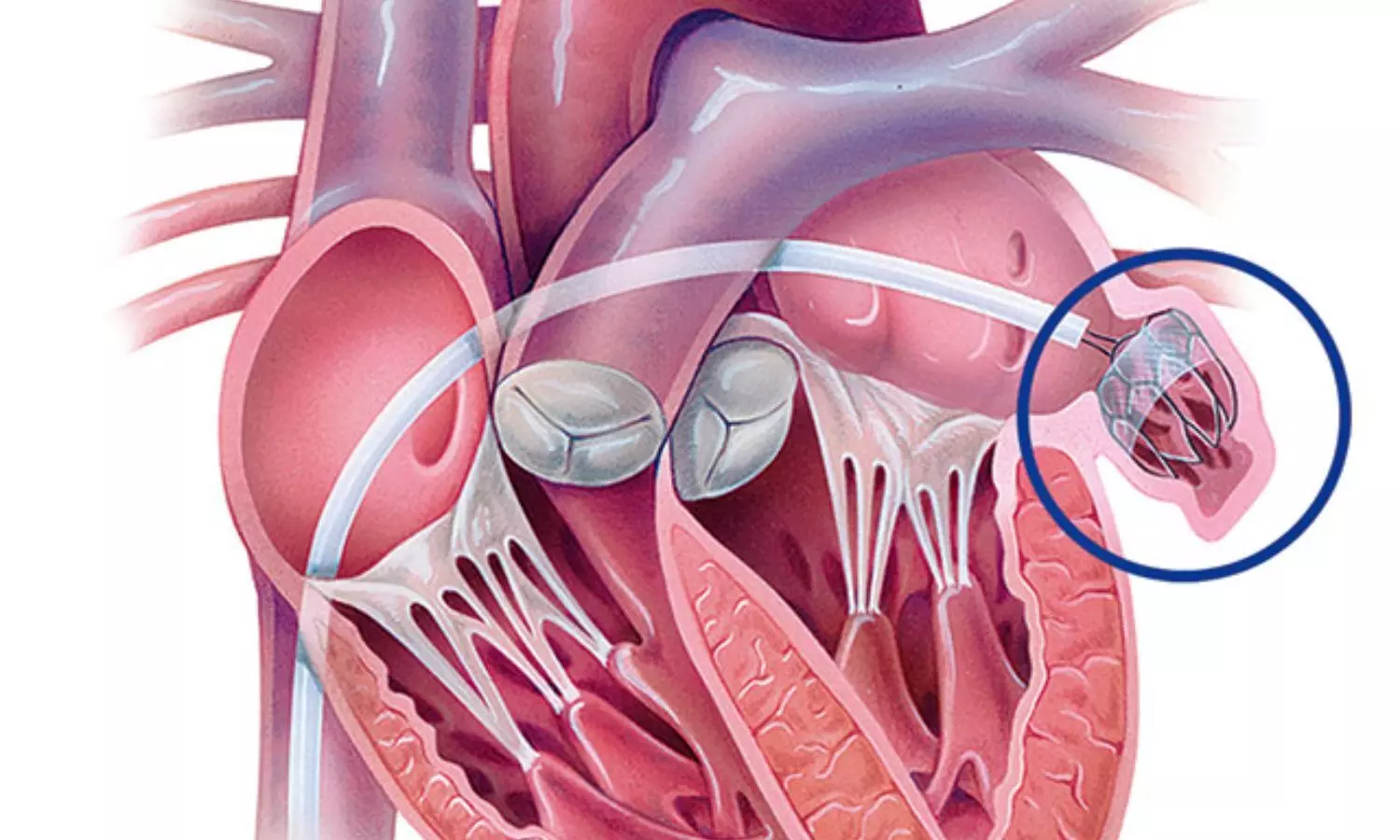 Read more about the article Left Atrial Appendage Closure Not Noninferior to Medical Therapy in High-Risk Atrial Fibrillation: Study