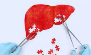 Read more about the article Thermal Ablation Shows Near-Zero Mortality in Liver Tumors,  finds research