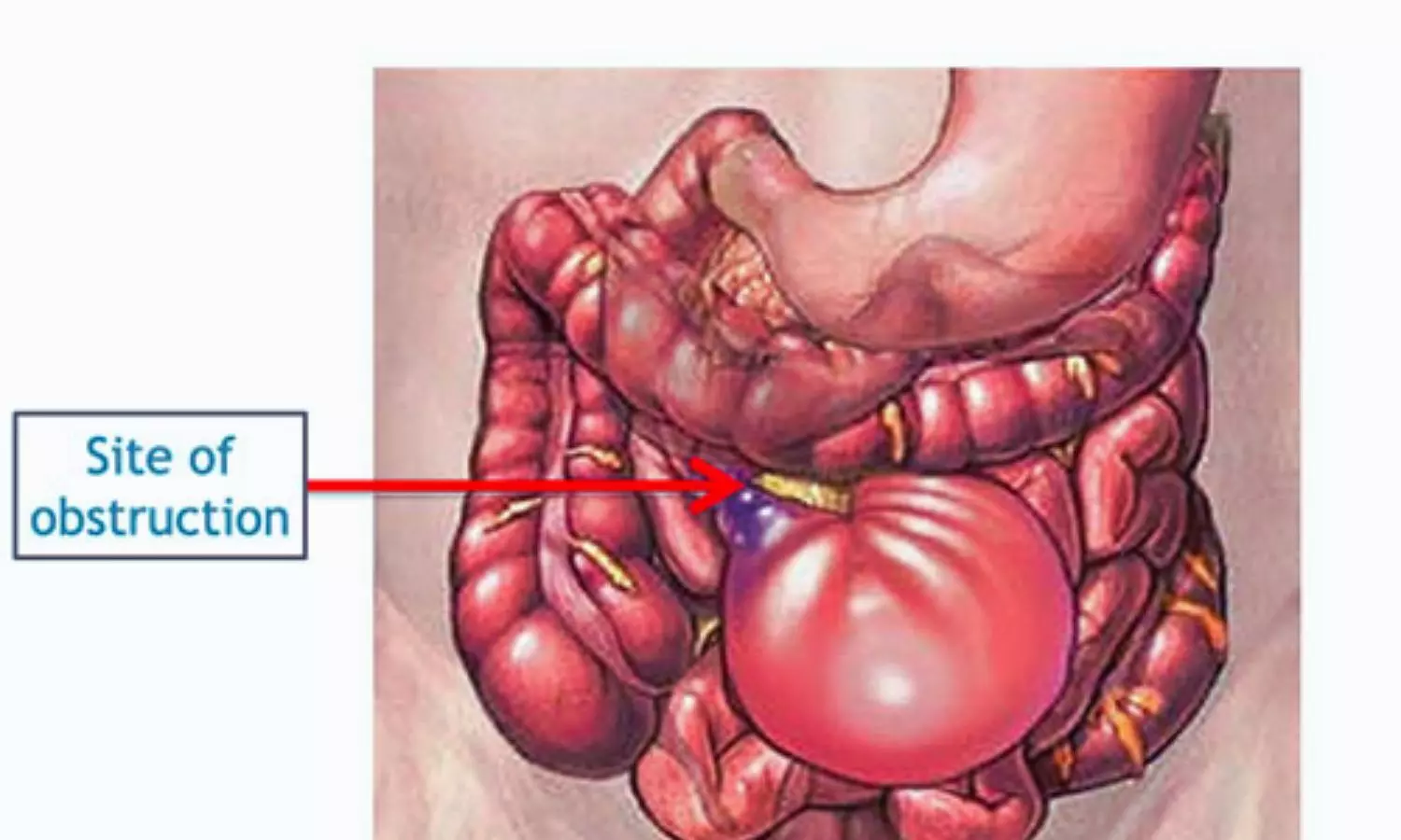 Read more about the article Laparoscopy Offers No Long-Term Edge Over Open Surgery in Small Bowel Obstruction: LASSO Trial
