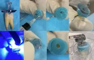 Read more about the article GentleWave technology Shows Promising Antibacterial Efficacy in Root Canal Therapy: Study