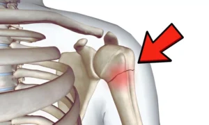 Read more about the article Study Finds Intramedullary Nailing Superior to Dual Plating in Selected Shoulder Fractures