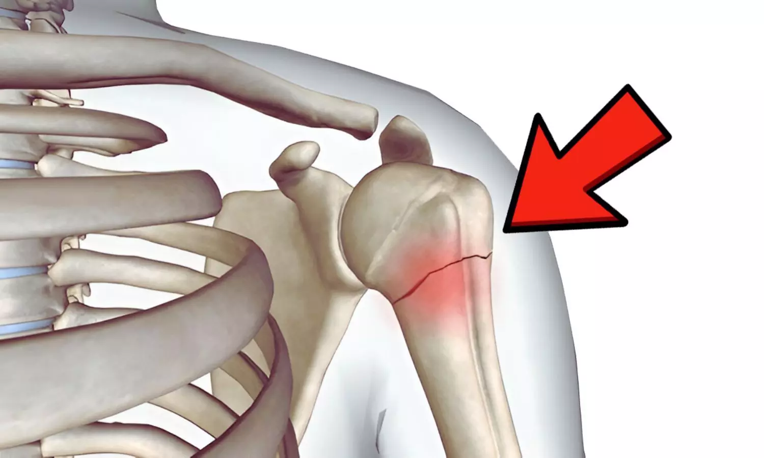 You are currently viewing Study Finds Intramedullary Nailing Superior to Dual Plating in Selected Shoulder Fractures