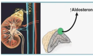 Read more about the article Higher Aldosterone-Renin Ratio Linked to AF and Stroke Risk in Older Adults: ARIC Study