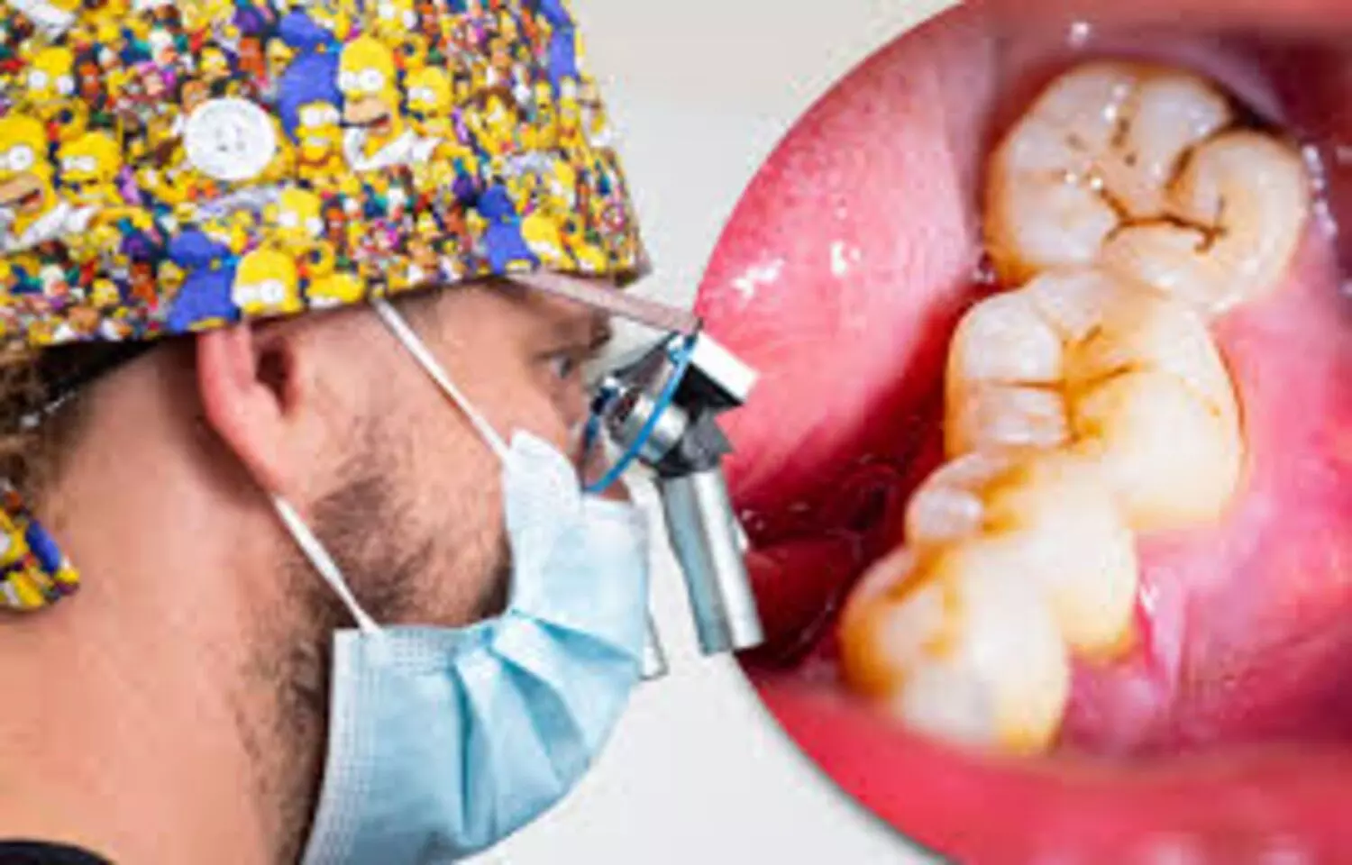 Read more about the article Magnification Loupes Improve Accuracy and Outcomes in Root Canal Treatment: Study