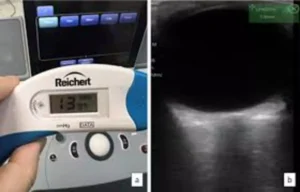 Read more about the article Tonsillar Retractor Use Raises ICP and IOP During Adenotonsillectomy: Study