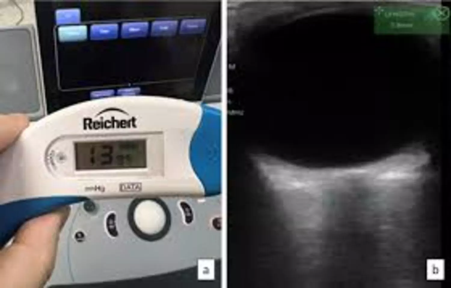 Read more about the article Tonsillar Retractor Use Raises ICP and IOP During Adenotonsillectomy: Study