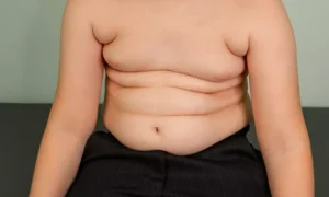 Read more about the article BMI Reduction Improves Cardiometabolic Risk in both metabolically healthy and unhealthy Obese Children: JAMA