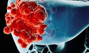 Read more about the article Percutaneous thermal ablation exhbits 
near-Zero Mortality, 3 Percent Complication Rate in small malignant liver tumors: Meta-Analysis