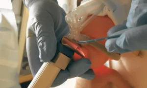 Read more about the article Early Caffeine Plus Less Invasive Surfactant Administration Fails to Benefit in Death or NDI in Preterm Infants on CPAP: JAMA