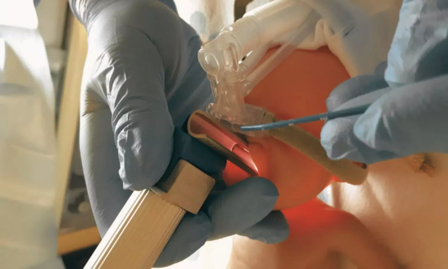 Read more about the article Early Caffeine Plus Less Invasive Surfactant Administration Fails to Benefit in Death or NDI in Preterm Infants on CPAP: JAMA