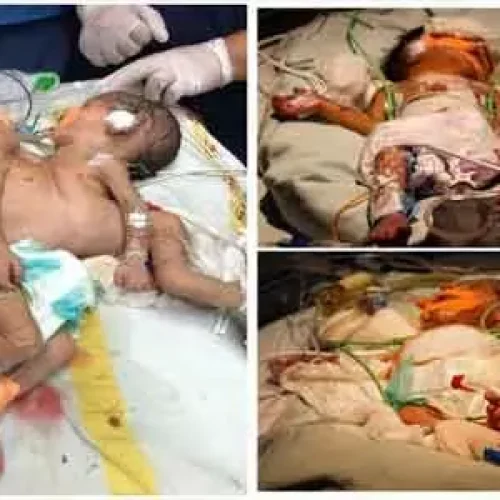 Tale of Two: Study Unraveling Mystery of TRAP Sequence in Monochorionic Twins