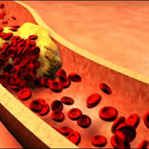 TyG-BMI Index Predicts Higher Mortality Risk in Osteoporosis Patients: Study