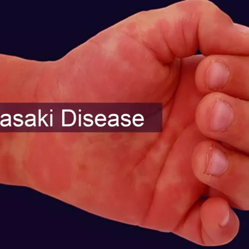 Patients with Kawasaki disease have increased risk of allergic diseases: BMC