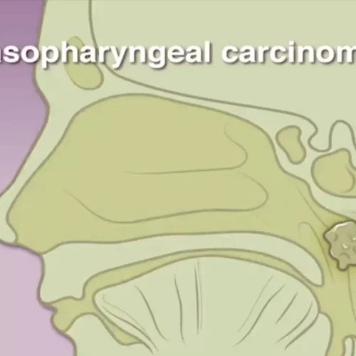 Toripalimab-Based Cisplatin-Free Strategy Efficacious, safe in Advanced NPC: JAMA