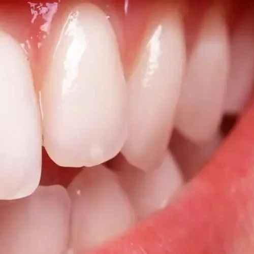 Short Fiber-Reinforced Composites may improve fracture resistance in posterior restorations: Study