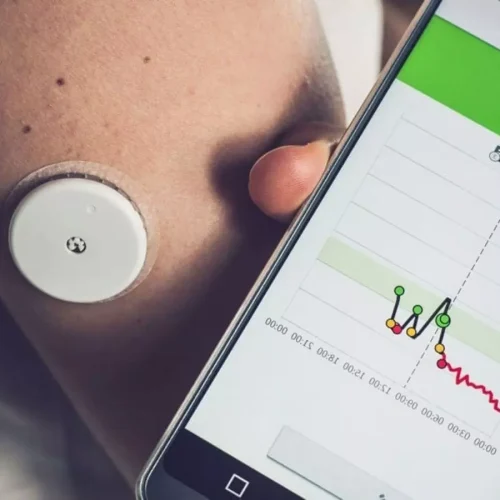 CGM may reveal insights into steroid-induced hyperglycemia: Study