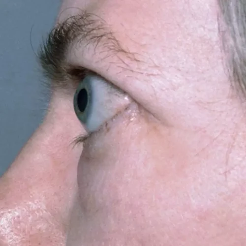 Smoking Increases Graves’ Disease Severity and Relapse Risk: Study