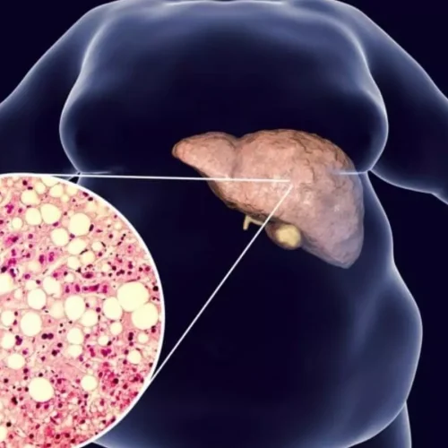 Fatty liver-but not liver damage-common in type 2 diabetes, suggests study