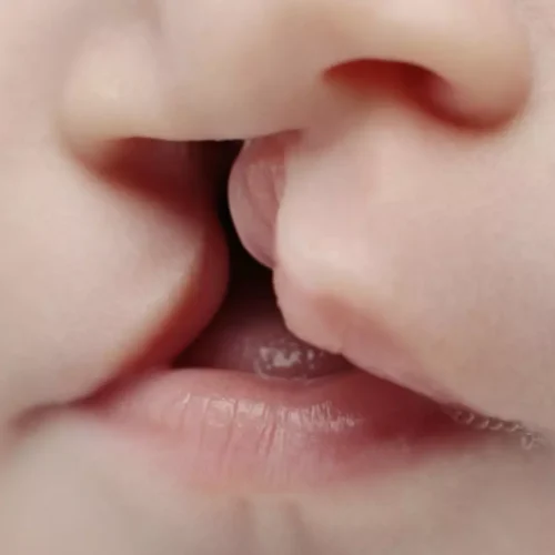 New classification system for nasal deformity in cleft lip and palate reported