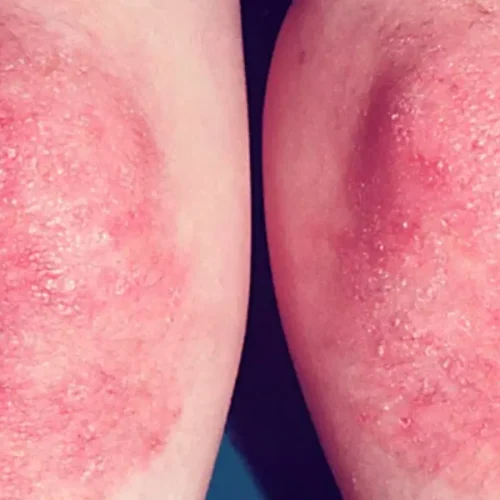 MMF-Based Regimen Shows Potential as Treatment Option for juvenile dermatomyositis: JAMA