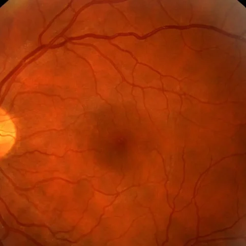 Long-Term Hydroxychloroquine Use Tied to Risk of Retinopathy, Reiterates Study