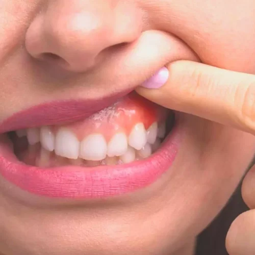 Severe Gum Disease Strongly Linked to Chronic Illnesses, Large U.S. Study Finds