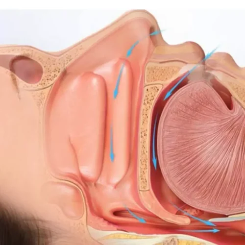 Undiagnosed Sleep-Disordered Breathing Worsens Heart Function in HCM Patients: JAMA