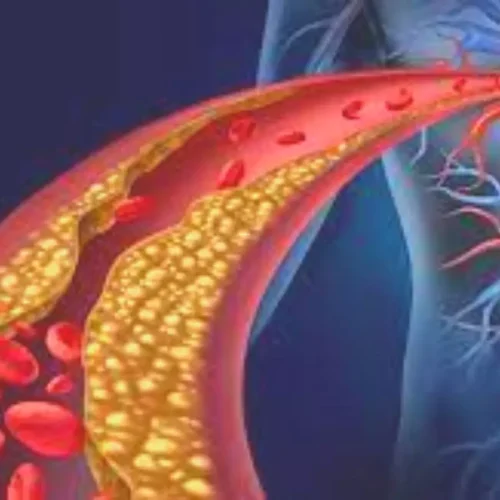 CT Angiography in Extreme Coronary Artery Calcium Score: JACC Adv., February 2026