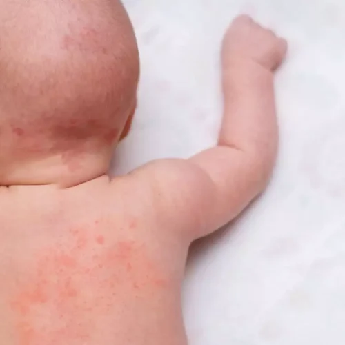 Children with Atopic Dermatitis not at Increased Cardiovascular Risk in adulthood: JAMA