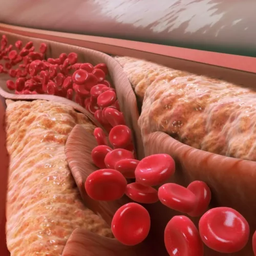“Goldilocks Zone” of Lipid Range to Minimize Mortality Risk: JACC Adv., February 2026