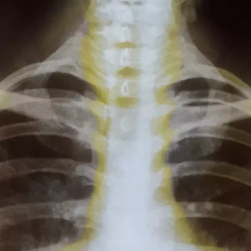 AI detects hidden objects on chest scans better than radiologists, reveals research