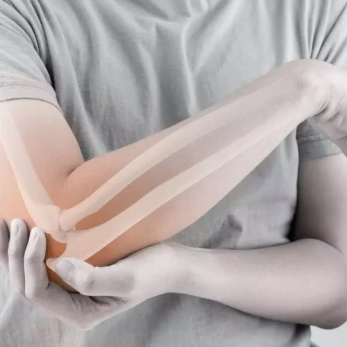 Casting Alone Proven as Effective as Surgery for Displaced Pediatric Elbow Fractures: Study
