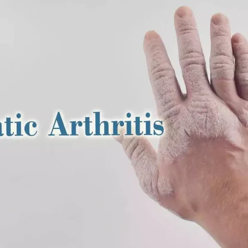 Metabolic Syndrome in Psoriatic Arthritis Linked to Degenerative Spine and heel issues: Study