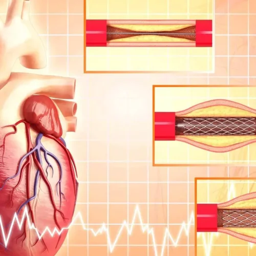 Selective Coronary Thrombectomy: CRM, June 2025 Study Finds No Increased Stroke Risk in High-Thrombus STEMI
