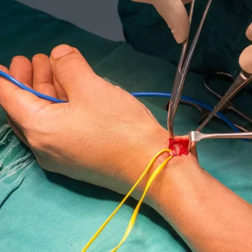Subcutaneous nitroglycerin effectively prevents radial artery occlusion in children: JAMA