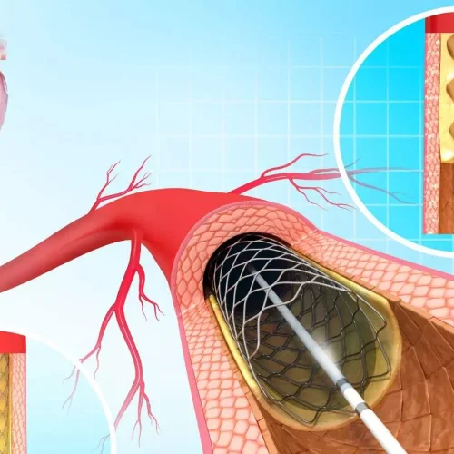 Coronary Injury Prevention: IHJ, 2025 Study Introduces Floating Aortic Wire Technique