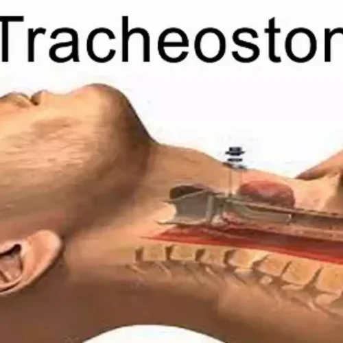 Petroleum Jelly Outperforms Saline in Preventing Tracheostomy Pressure Injuries: Study