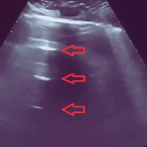 Lung Ultrasound Aids Early Delirium Detection in Resource-Limited Settings: Study