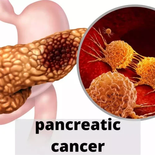 Mild Pancreatic Duct Dilatation Linked to Pancreatic Cancer Risk: Study