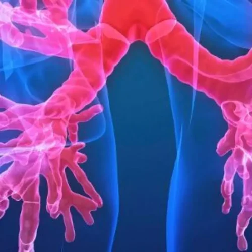 Symptoms Predict Exacerbation Risk in Bronchiectasis, Suggesting Expanded Role for Macrolide Therapy: Study Finds