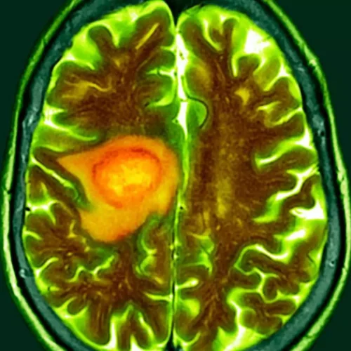 Proton Pump Inhibitors Linked to Worse Survival in Newly Diagnosed Glioblastoma: Study