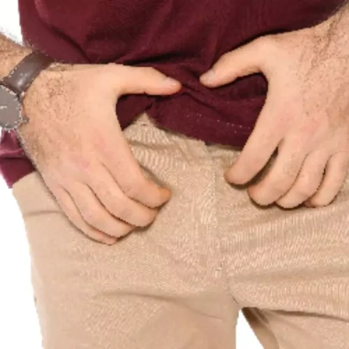 Apremilast Shows Sustained Benefit in Genital Psoriasis: Study